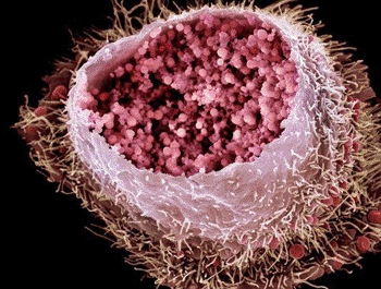 Image: Colored scanning electron micrograph of a cultured human cervix cancer cell infected by Chlamydia trachomatis bacteria (Photo courtesy of SPL).